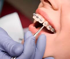 Implantes Dentários - miniatura 2